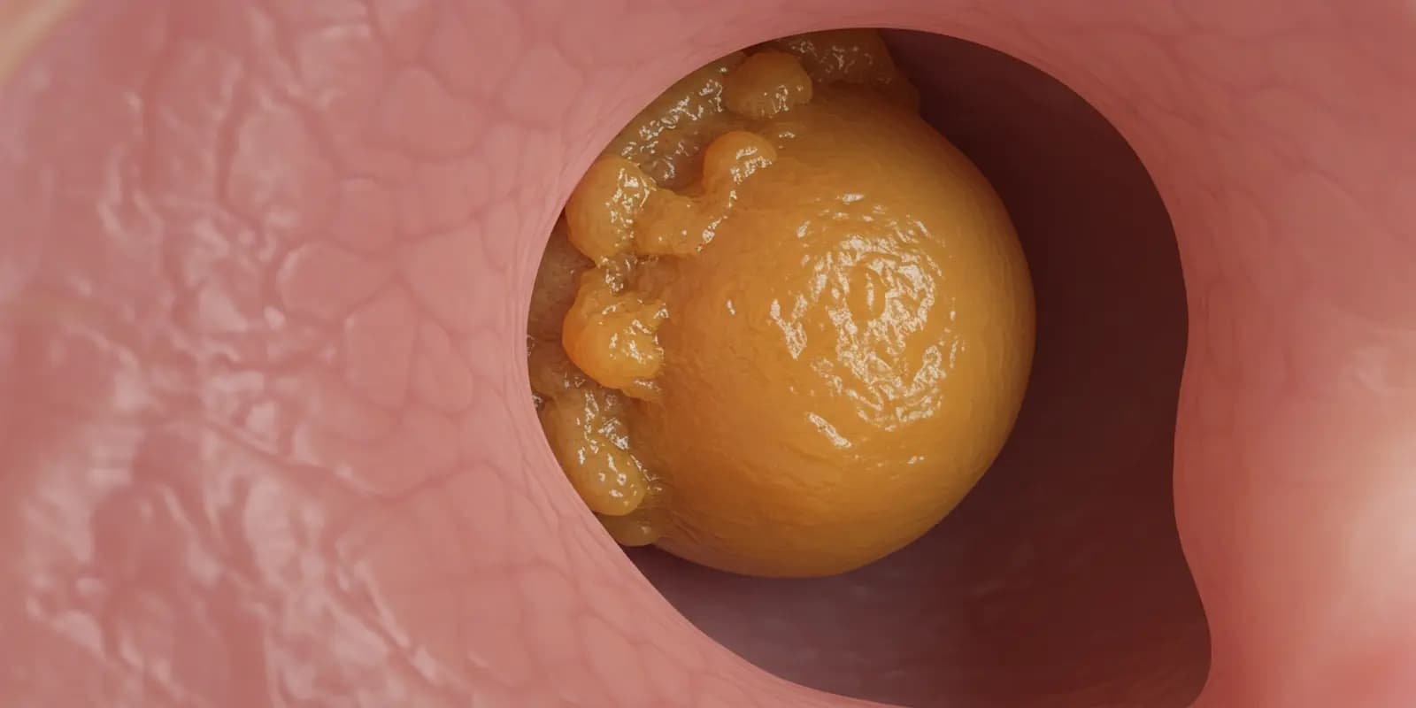Image showing a buildup of earwax (cerumen) within the passage of the ear.